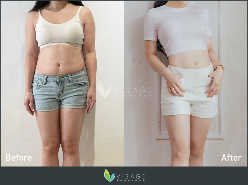 ｜威塑抽脂＋超能電漿｜完美的體態就是我想追求的-0