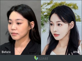 韋志曄醫師_結構式隆鼻