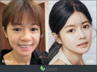 結構式隆鼻_韋志曄醫師案例封面